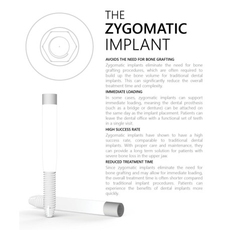Zygomatic Implant